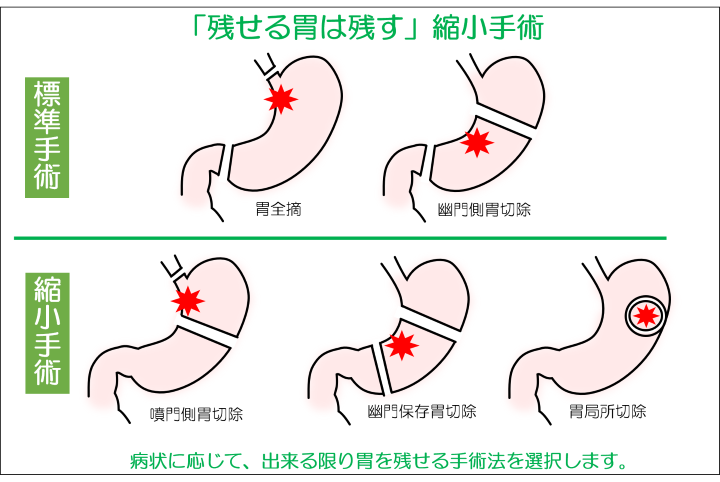 残せる胃は残す縮小手術