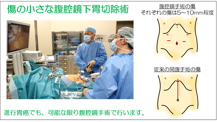 傷の小さな腹腔鏡下胃切除術