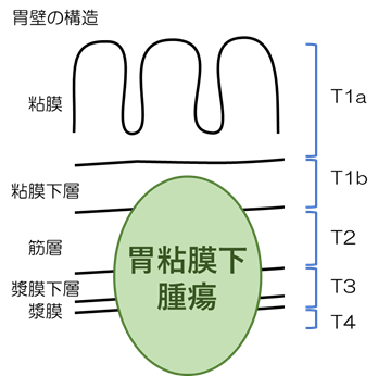 胃胃粘膜下腫瘍、胃GISTの手術治療