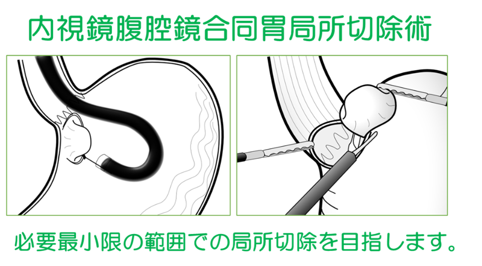 内視鏡腹腔鏡同胃局所切除術