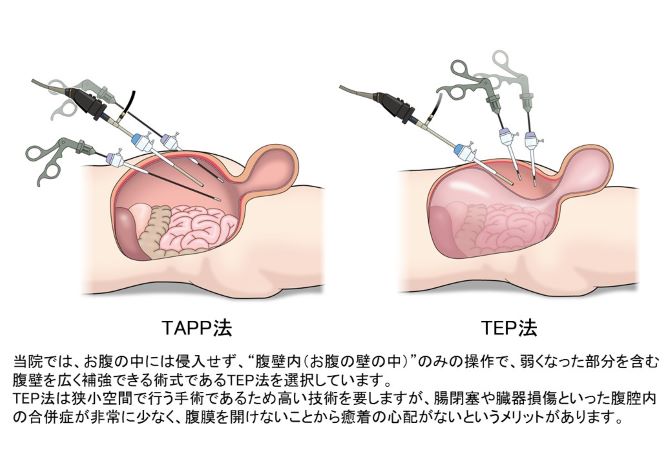TAPP_vs_TEP