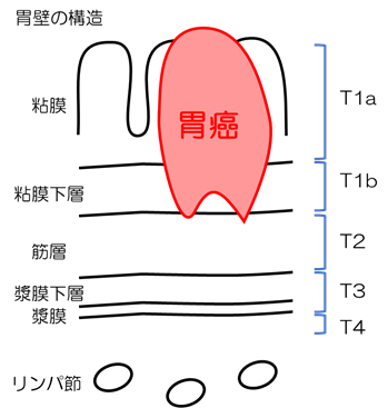 胃がんとは？